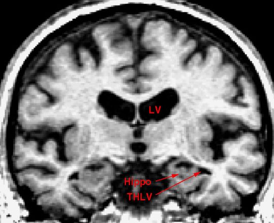 In this file photo, the brain of an older individual shows the early stages Alzheimer's disease. A new study suggestions a gum infection might be linked to the disease. (Photo: DEPARTMENT OF ANATOMY AND NE)